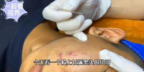 去黑头视频,告别毛孔烦恼——跟随视频教程学技巧