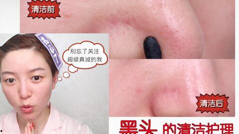 去黑头视频,告别毛孔烦恼——跟随视频教程学技巧