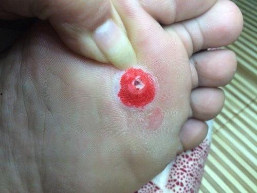 鸡眼挖出来的肉刺视频,真实视频呈现