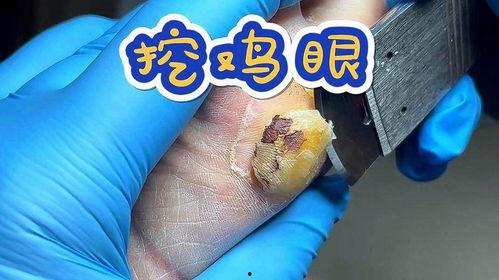 鸡眼挖出来的肉刺视频,真实视频呈现