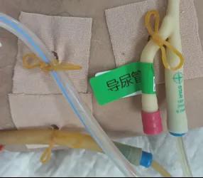 导尿管视频,导尿管操作步骤及注意事项详解