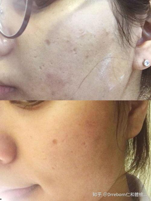 去痘痘视频,跟随去痘视频，轻松拥有无瑕肌肤