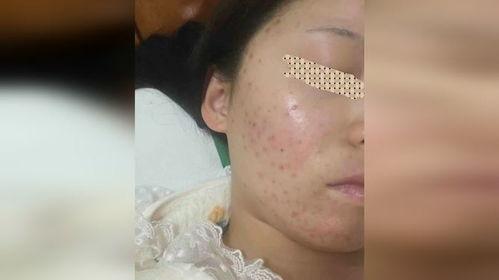 去痘痘视频,跟随去痘视频，轻松拥有无瑕肌肤