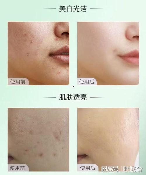 去痘痘视频,跟随去痘视频，轻松拥有无瑕肌肤