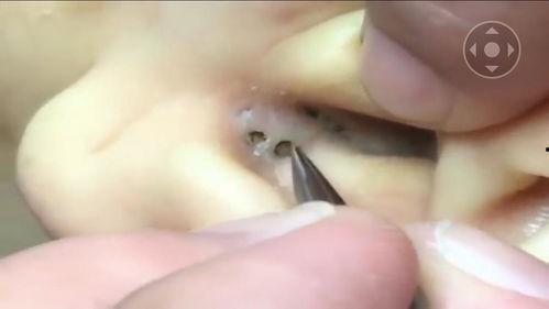 耳朵黑头视频,视频教你轻松清洁