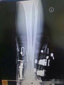腿骨折视频