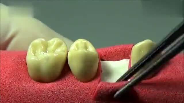 种植牙视频播放,视频带你领略牙医技艺